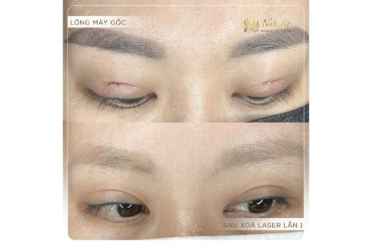 xoa-xam-long-may-co-het-hoan-toan-duoc-khong (2)